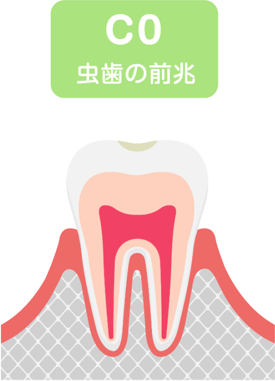 C0 虫歯の前兆