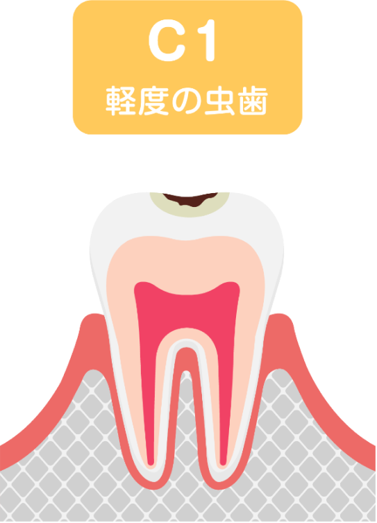 C1 軽度の虫歯