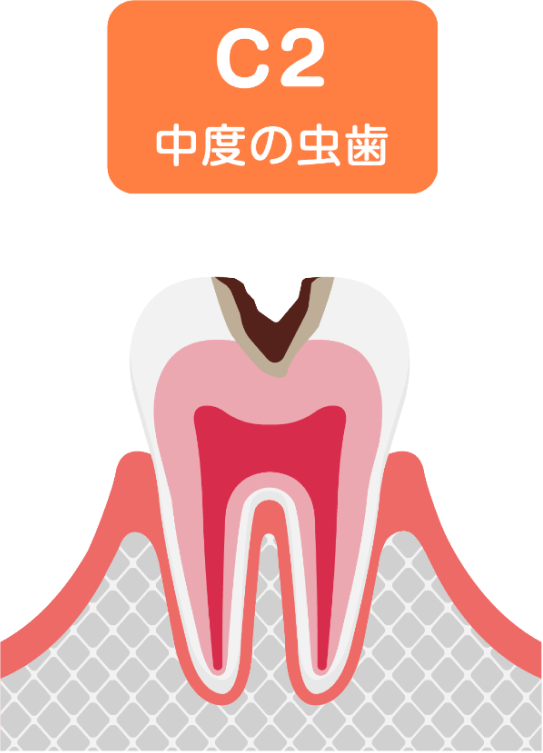 C2 中度の虫歯
