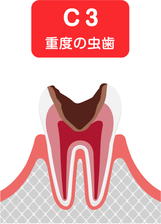 C3 重度の虫歯