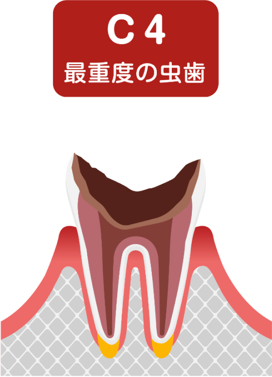 C3 最重要の虫歯