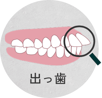 出っ歯