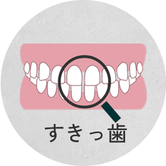 すきっ歯