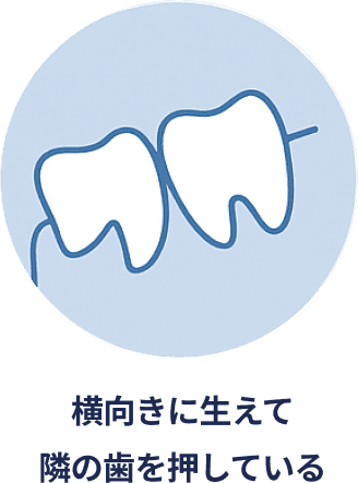 横向きに生えて隣の歯を押している