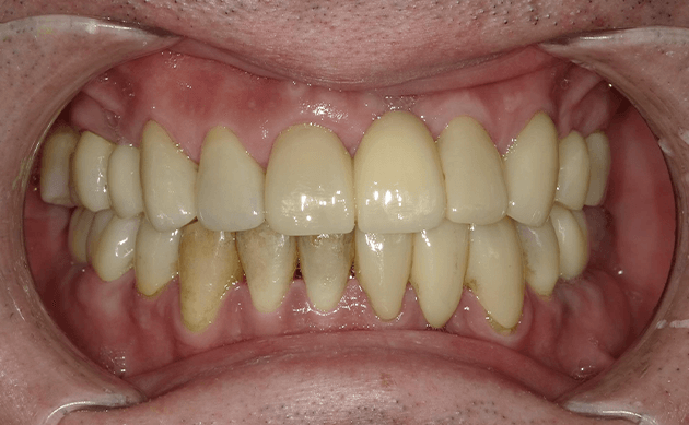 前歯の色が変わってきてしまいうまく笑顔を作れなくなってしまった方の治療