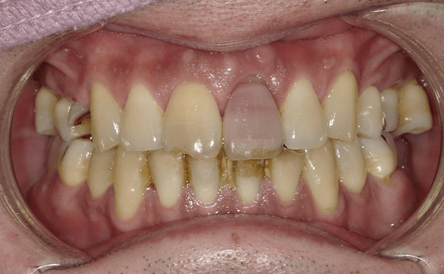 前歯の色が変わってきてしまいうまく笑顔を作れなくなってしまった方の治療