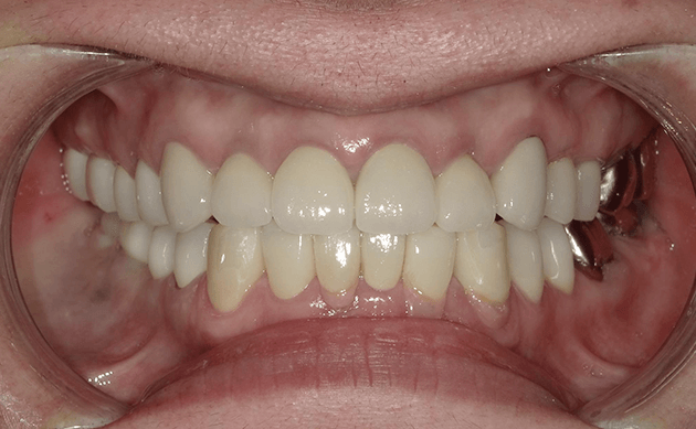 被せ物が古くなって噛み合わせも悪くなってきてしまった方の治療