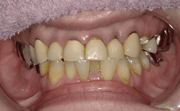 被せ物が古くなって噛み合わせも悪くなってきてしまった方の治療