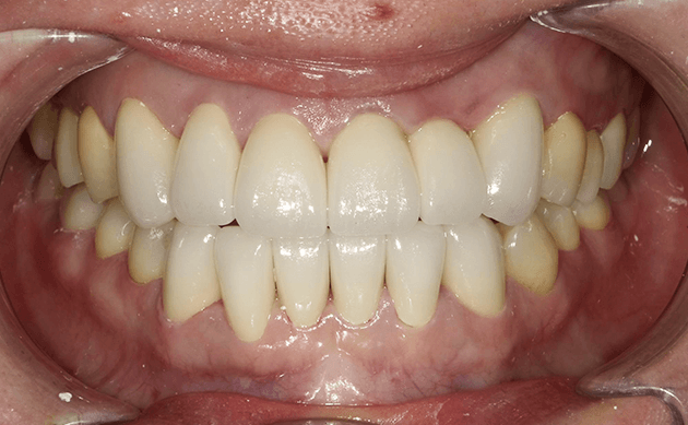 長年前歯の見た目に悩まされていた方の治療