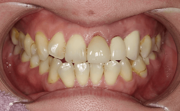 長年前歯の見た目に悩まされていた方の治療