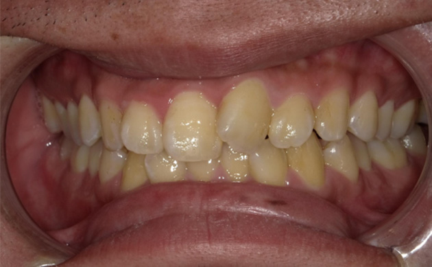 営業マンとして日々忙しく過ごす中で、短期間で歯並びを治したいと希望された方の治療