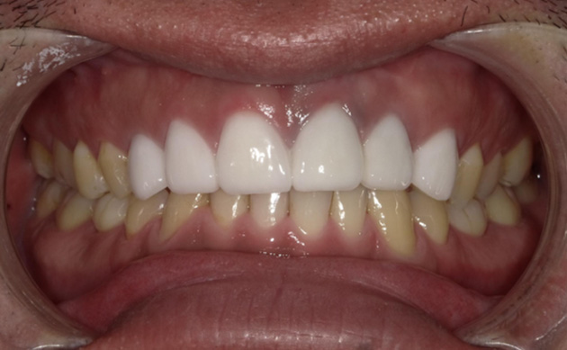 気づいた時には歯と歯の隙間が大きく広がっていってしまった患者様