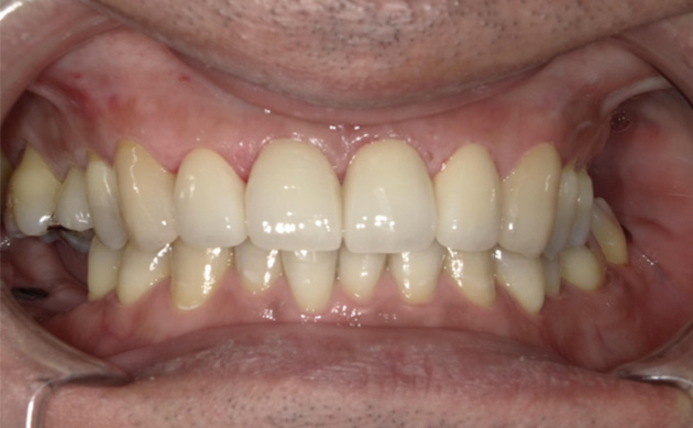 忙しさで歯科医院に通えず、前歯のむし歯を10年以上放置してしまった患者様