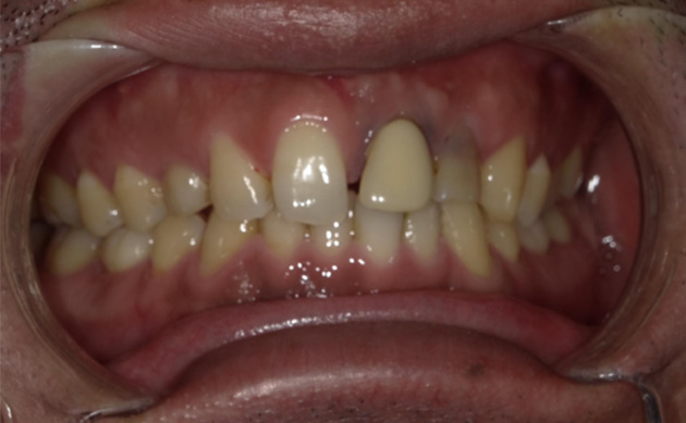 気づいた時には歯と歯の隙間が大きく広がっていってしまった患者様