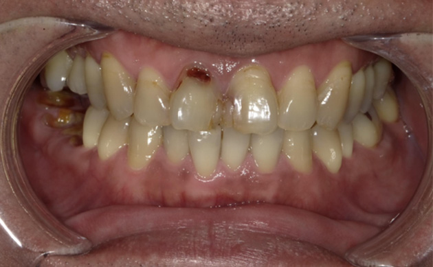 忙しさで歯科医院に通えず、前歯のむし歯を10年以上放置してしまった患者様