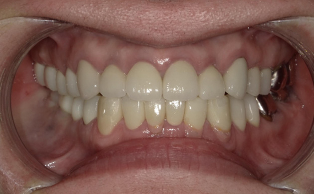 ほぼ全ての歯に保険の被せ物があり、歯間に食べ物が詰まりやすく食事がしにくいとご相談された患者様