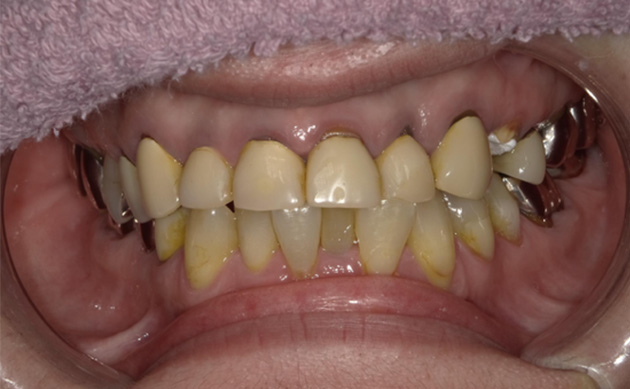 ほぼ全ての歯に保険の被せ物があり、歯間に食べ物が詰まりやすく食事がしにくいとご相談された患者様