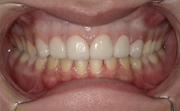 すきっ歯をできるだけ短期間で痛みなく治したいと希望された患者様