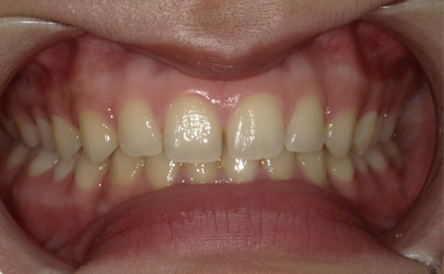 すきっ歯をできるだけ短期間で痛みなく治したいと希望された患者様