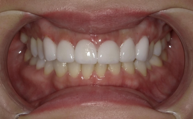 不揃いな歯の形を綺麗にしたいとご希望の患者様