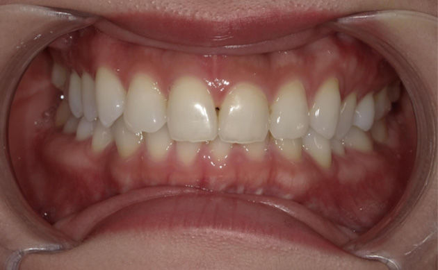 不揃いな歯の形を綺麗にしたいとご希望の患者様