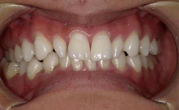 笑った時に見える範囲だけセラミックにしたいとご希望の患者様