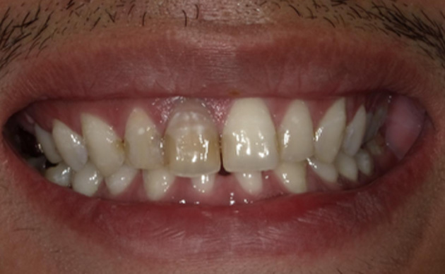 黒く変色した歯をセラミックで自然な白さにしたいとご希望の患者様