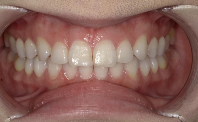 前歯の不自然さを美しく治したいとご希望の患者様