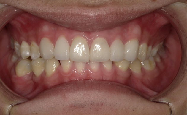 歯の形を整えたいとご希望の患者様