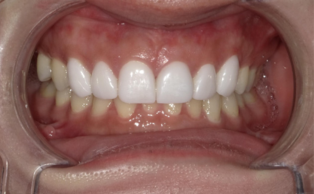 笑った時に見える範囲だけセラミックにしたいとご希望の患者様