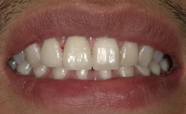 黒く変色した歯をセラミックで自然な白さにしたいとご希望の患者様