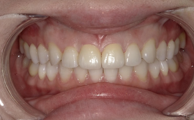 前歯の不自然さを美しく治したいとご希望の患者様