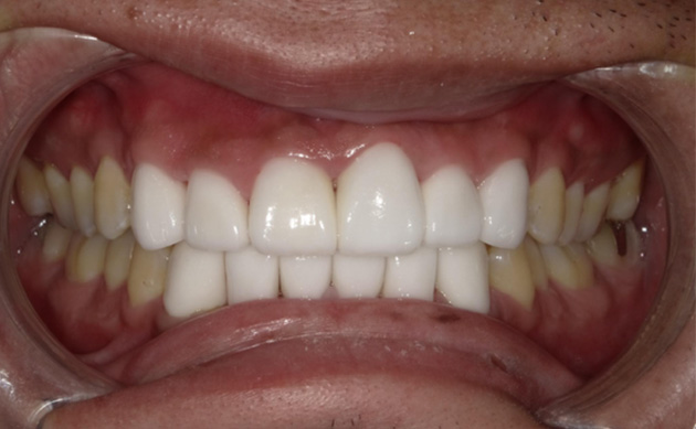 営業マンとして日々忙しく過ごす中で、短期間で歯並びを治したいと希望された方の治療