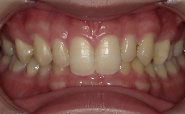 生まれつき長い前歯2本をセラミックで綺麗に整えたいとご希望の患者様