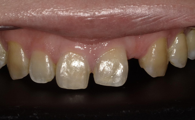 生まれつき前歯が1本少ないことに悩まれていた患者様