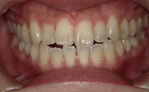 開咬の歯並びに悩まれた患者様