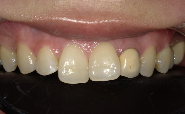 古くなった被せ物と歯並びにお悩みだった患者様