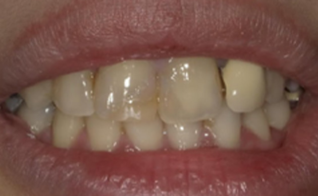 前歯の虫歯と被せ物を同時に治したいとご希望の患者様