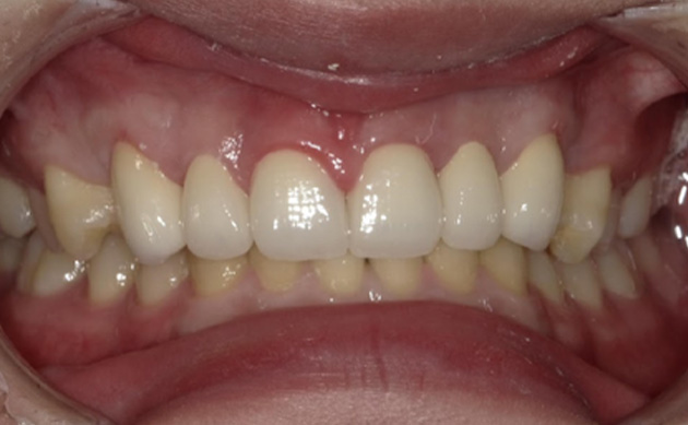 生まれつき長い前歯2本をセラミックで綺麗に整えたいとご希望の患者様