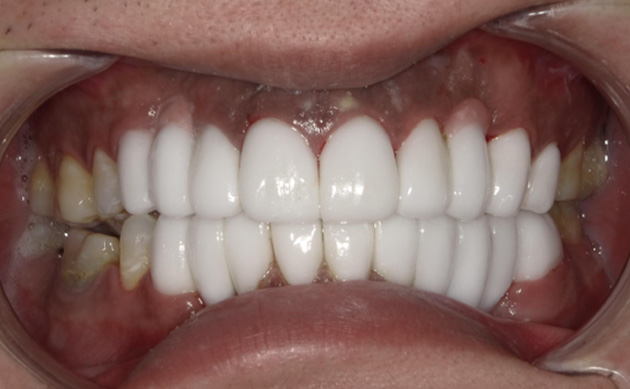 痛みへの不安からこれまでほとんど歯科受診の経験がなかった患者様