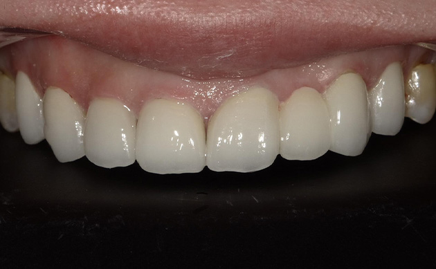 生まれつき前歯が1本少ないことに悩まれていた患者様