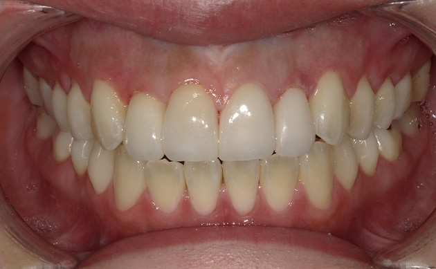 開咬の歯並びに悩まれた患者様