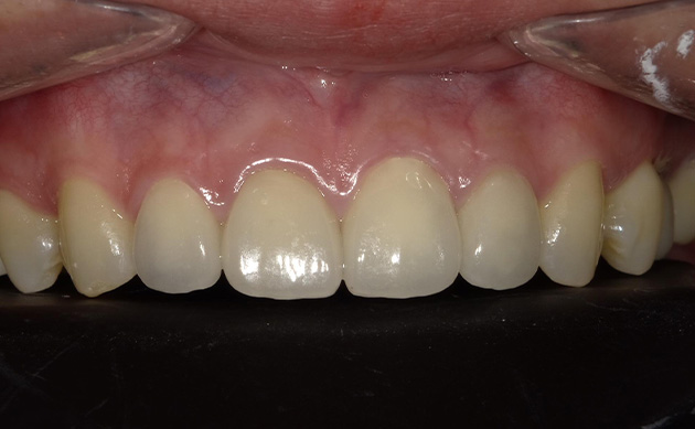 古くなった被せ物と歯並びにお悩みだった患者様