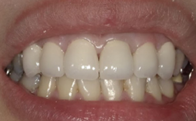 前歯の虫歯と被せ物を同時に治したいとご希望の患者様