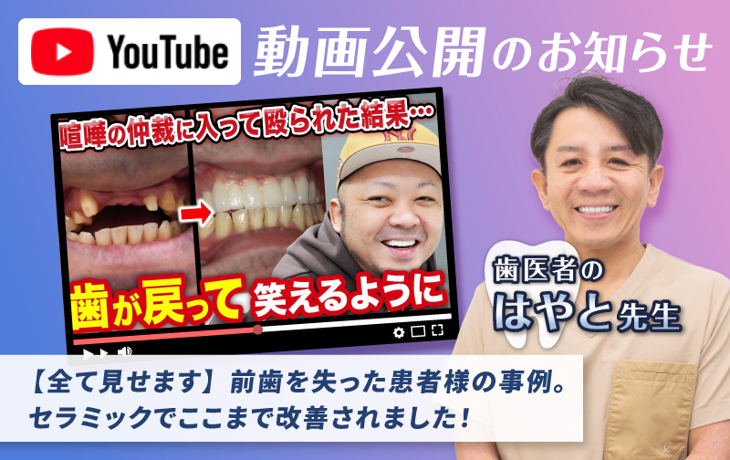 前歯を失った患者様の事例。セラミックでここまで改善されました！