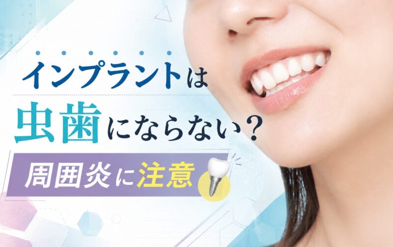 インプラントは虫歯にならない？周囲炎に注意