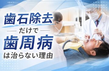 歯石除去だけで歯周病は治らない理由